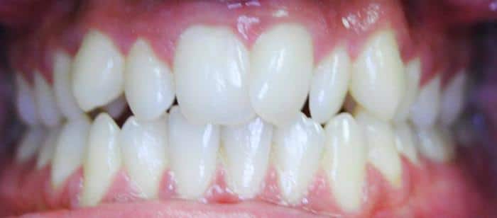 AdultTeen-Crowding-Invisalign-Before