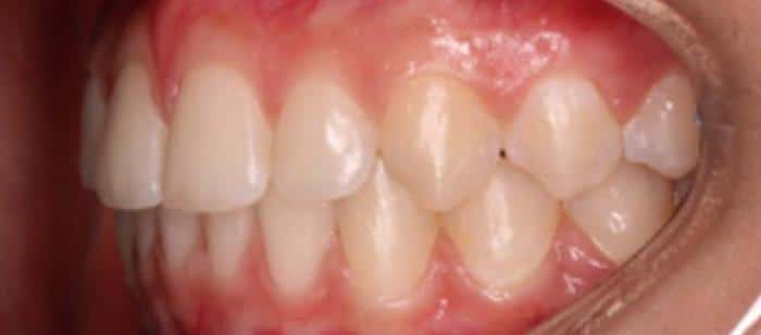 AdultTeen-Flared-Teeth-Invisalign-After