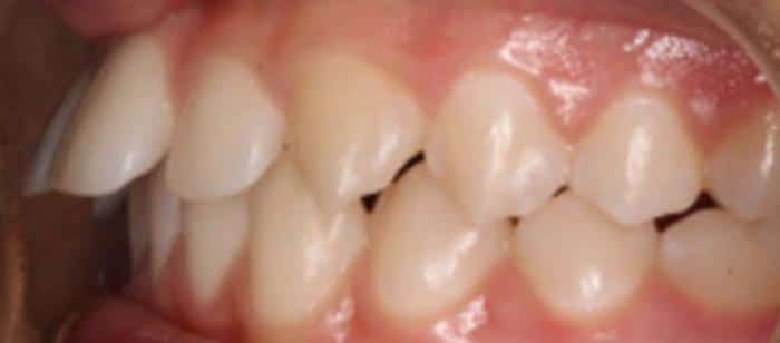 AdultTeen-Flared-Teeth-Invisalign-Before