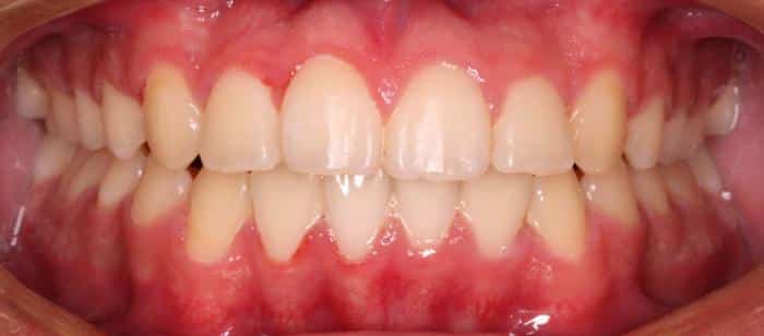 AdultTeen-Open-bite-After