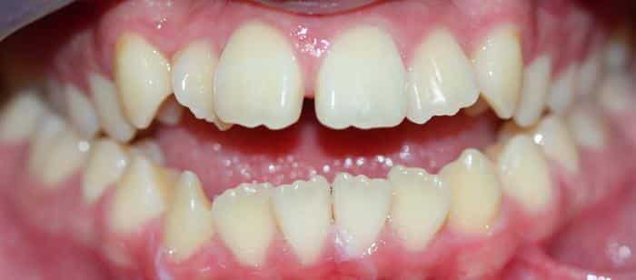 AdultTeen-Open-bite-Before