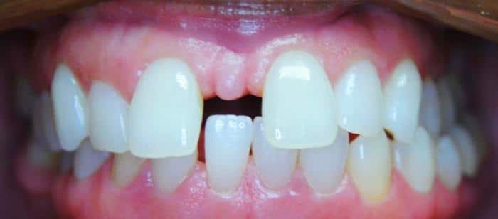 AdultTeen-Spacing-and-Crossbite-Before (1)