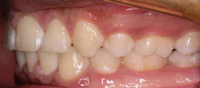 AdultTeen-Tooth-Extractions-After