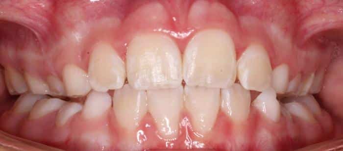 Phase-1-Treatment-on-Children-After