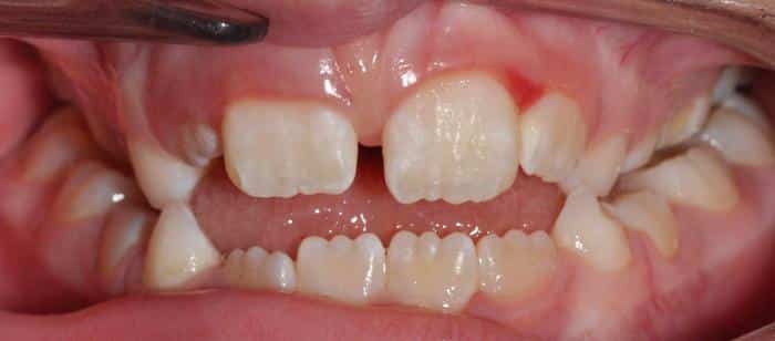 Phase-1-Treatment-on-Children-Before