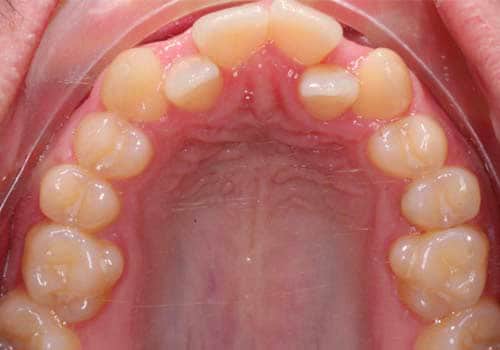 Tomblyn-AdultTeen-Expansion-Before-1-